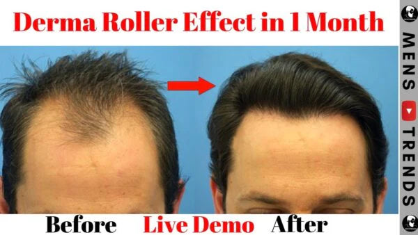 Hair Growth Roller
